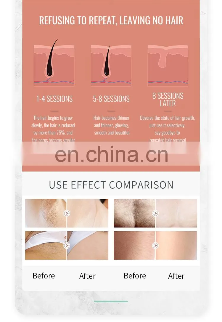 Medical CE TUV 755 808 1064 Diode Laser Hair Removal/ 808nm Diode Laser Hair Removal Machine
