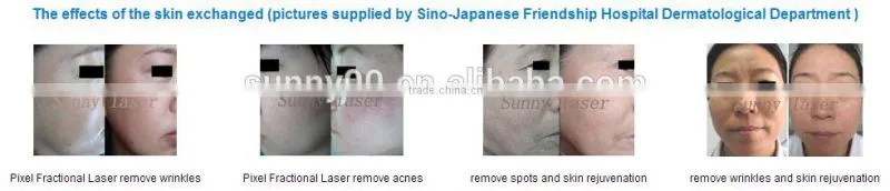good quality pixel co2 fractional laser
