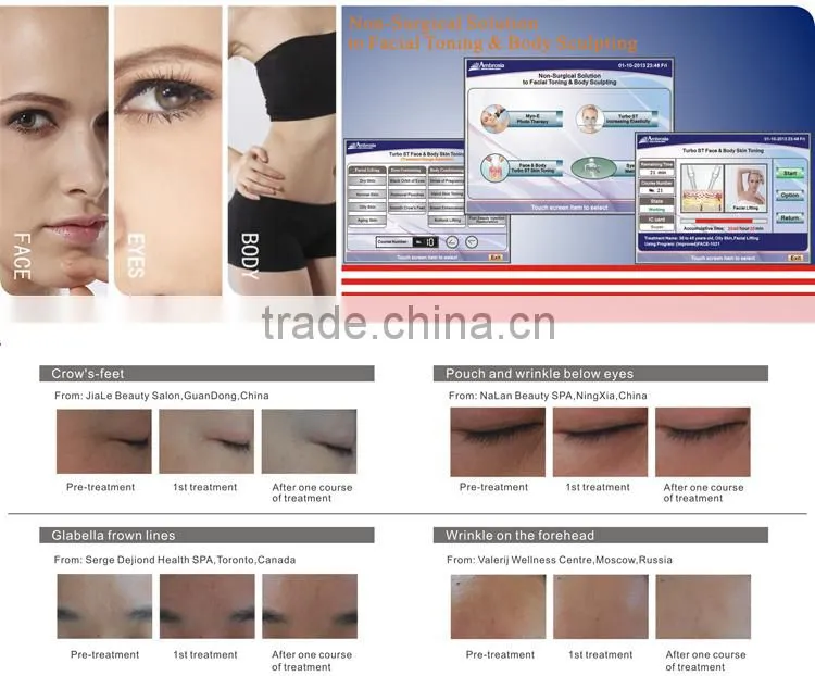 Non Surgical Facial Toning and Anti-wrinkle Beauty Machine