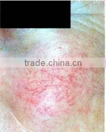 Excellent portable red vascular laser treatment
