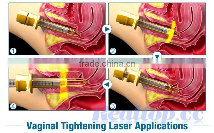 skin resurfacing vaginal tightening laser equipment co2 fractional beauty salon instrument for sale vaginal tightening device