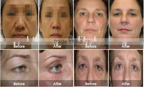 korea u-one HIFU multifunction beauty machine for face lift and wrinkle removal