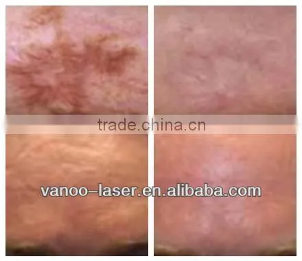 30W fractional Laser resurfacing fractional Co2 laser