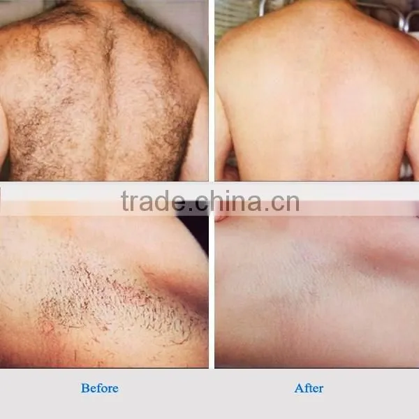 new technology 808 diode laser remove hair machine