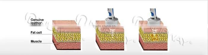 2015 new design portable HIFUSHAPE slimming machine high intensity focused ultrasound hifu