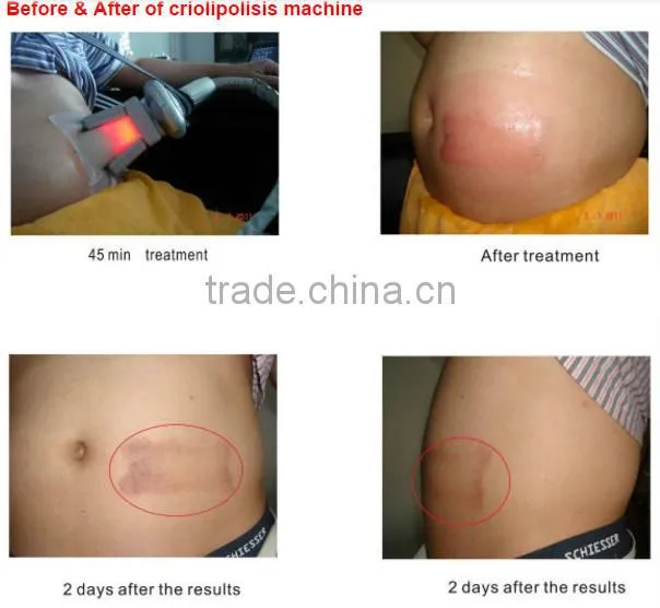 Hot sale lowest temperature to -10 home m-cryo6s skin cooling device
