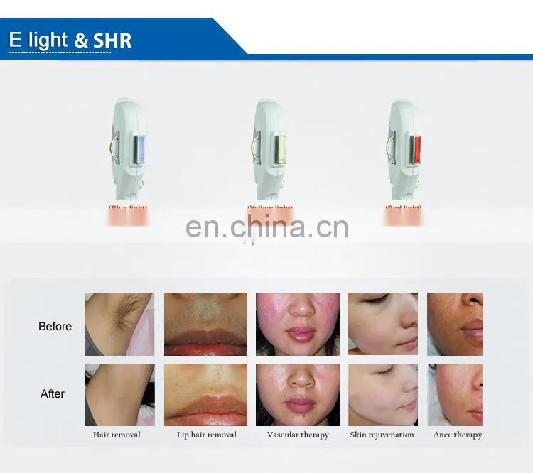 Guangzhou Renlang IPL Hair-removal Depilator Machine Good Price for You to Sale