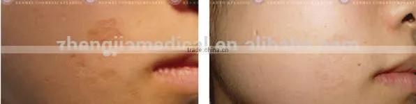 2015 newest vertical salon use RF machine/ facial tightening/ wrinkle remover