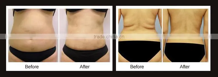 tummy tuck/liposuction without surgery/liposuction surgery