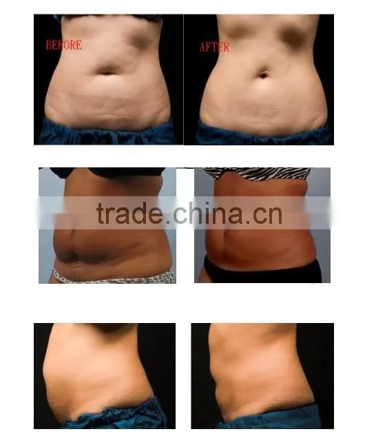 OL-1001B facial skin Ultrasonic cavitation beauty machines slimming equipment with CE approval