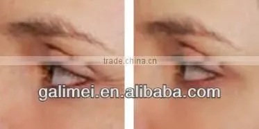 Home use Auto Micro Needle Device with CE