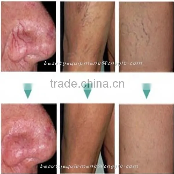 Professional RBS spider vein removal machine with best treatment effect
