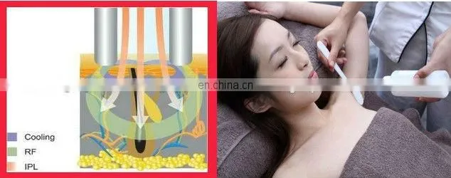 Spa use!!! portable ipl elight machine for men permanent hair removal