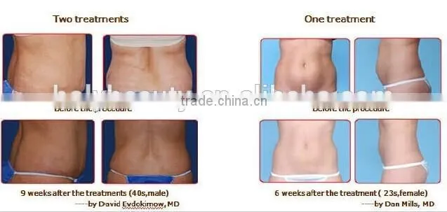Profession body slimming and cellulite treatment machine