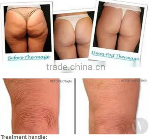 newest China supplier factory direct sale price portable fractional rf face lift machine