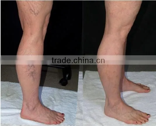 Nd Yag Laser for Varicose Veins/blood Vessel/ hair laser removal machine