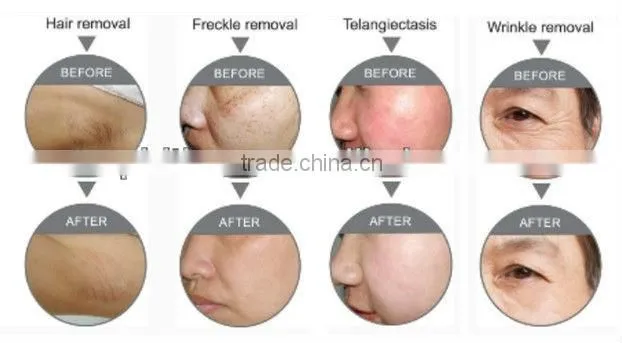 The Best Portable IPL Machine Master IPL
