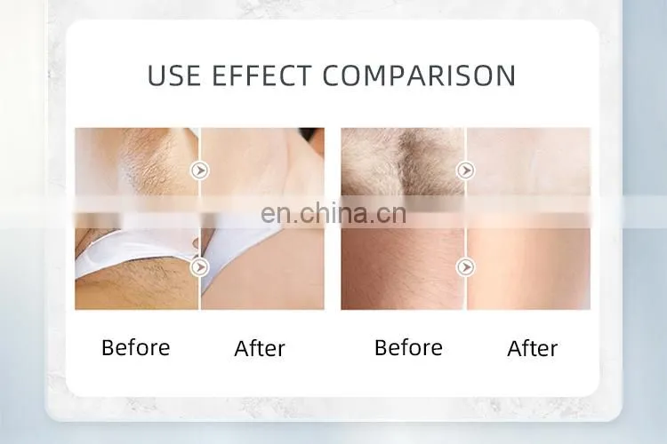 High Power Three Wavelengths Diode Laser Hair Removal Machine