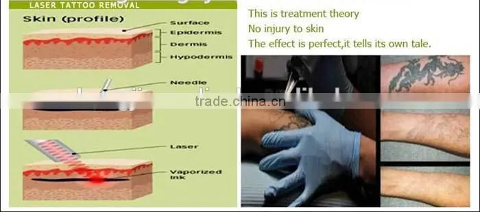 2014-Newest Portable laser tattoo removal machine,Nd-yag skin whitening machine