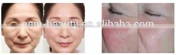 High technology Fractional rf radio frequency machine for face and body face lifting -F-TJ03