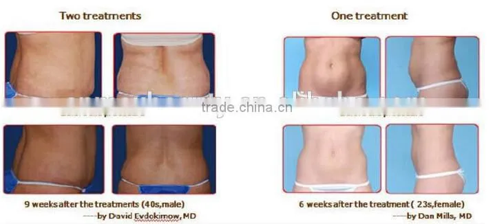 Hot Sale factory price fat freezing machine for home use / fat freezing