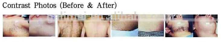 FDA and 2 years warranty High quality excellent effect ipl shr laser removal machine