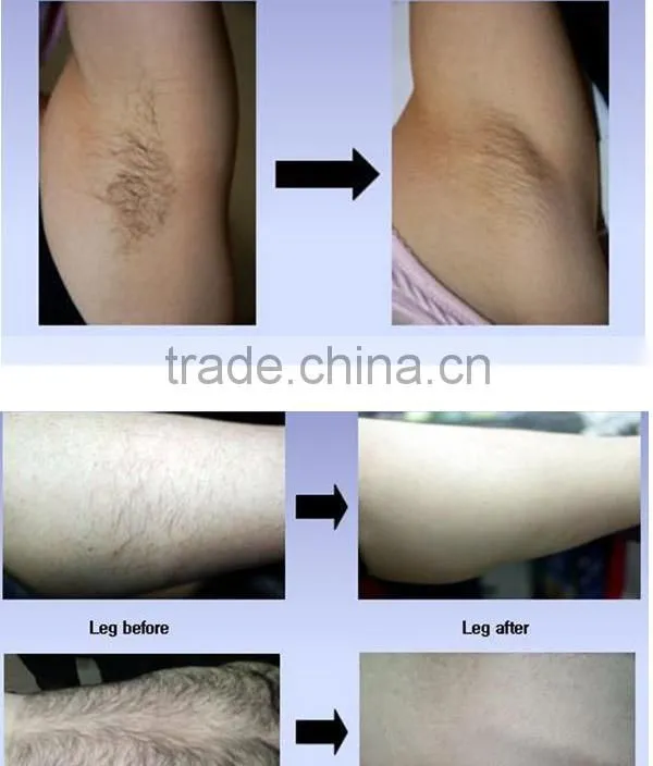 Professional 808NM diode laser 6 types skin hair removal equipment price