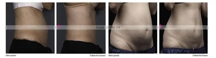 Merry christmas! professional high intensity focused ultrasound slimming weight balance lipo hifu machine