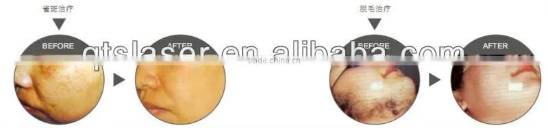 Buy quality elight ipl rfs products from elight ipl rfs manufacturers elight ipl rfs Manufacturers & Suppliers from China