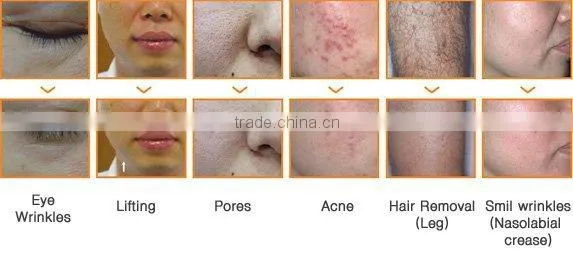 ipl laser hair remov multifunction ipl epilation