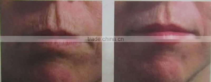 # portable fractional co2 laser equipment for acne scar removal