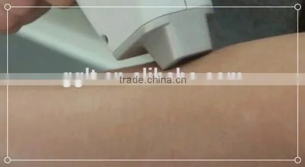 2015 hot sell 808 diode laser machine system removing hair of arm legs and bikini