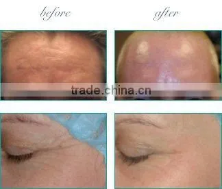 CO2 fractional laser machine for wrinkle removal