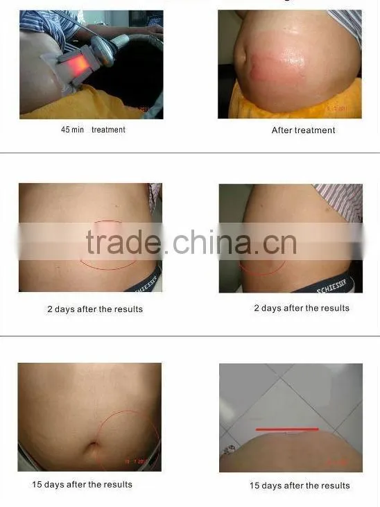 LN-164S freezing fat lipo cryo machine
