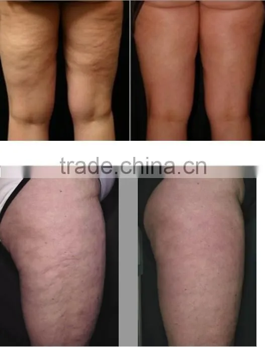 Top selling products 2015 Shock Wave Therapy cavitation rf vacuum salon equipment