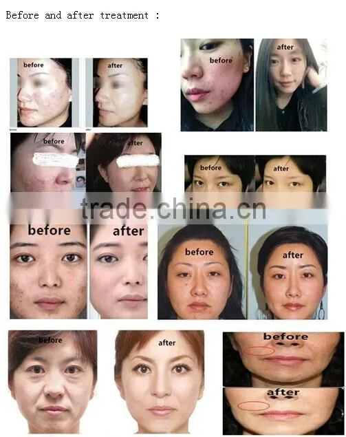 high preformance portable fractional wrinkle removal microneedle rf machine price for clinic hospital beauty spa