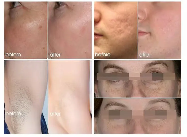 Portable DPL Optical Skin Beautification Skin Rejuvenation BBL Pigmentation 480nm Dpl Freckles Age Spots Removal