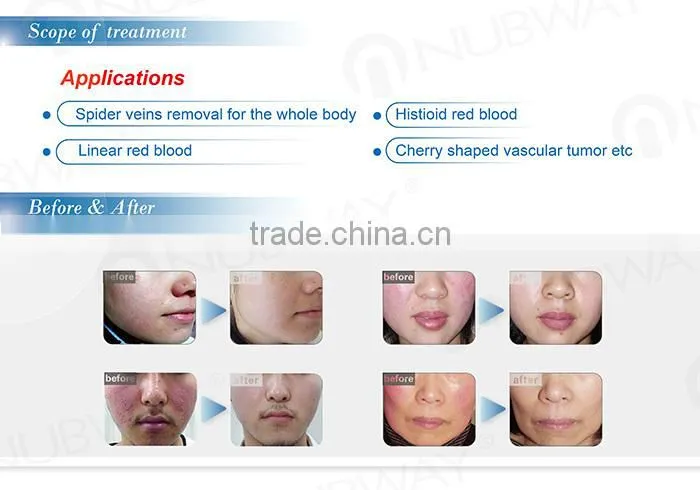 Spider vein removal and cherry shaped vascular surgical machine