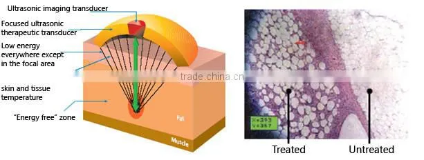 Ultrasound HIFU Liposonix Body Contouring Shaping With Fast Effect