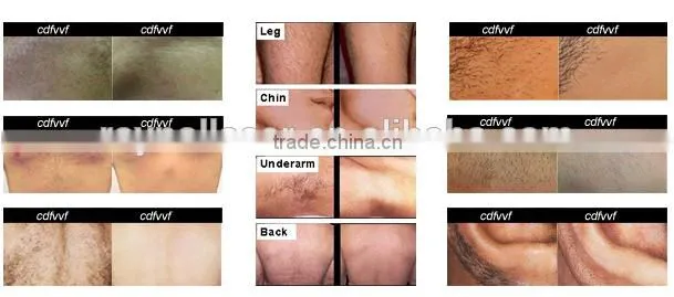Promotion!!! Hair Removal IPL SHR Machine For Sale IPL SHR Hair Removal
