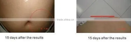 cryolipolysis beauty salon equipment