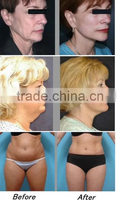 Galvanic Wrinkle Removal Equipment Machine(Missface-80)