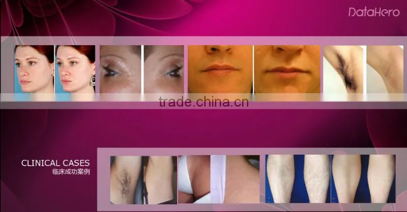 Portable ipl hair removal, home use ipl laser, ipl machine handly