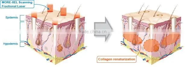 Fractional Co2 laser for skin rejuvenation, Co2 fractional laser machine scars removal & acne treatment