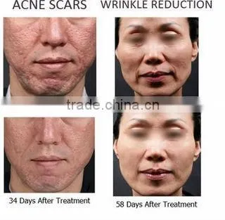 Best Effective !!! Skin rejuvenation and beauty treatment fractional rf microneedle device