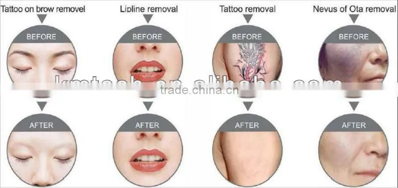 laser q-switch nd yag laser pigmentation removal