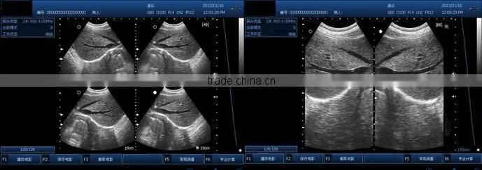 Excellent Portable Wireless Ultrasound Transducers for sale -WBU01