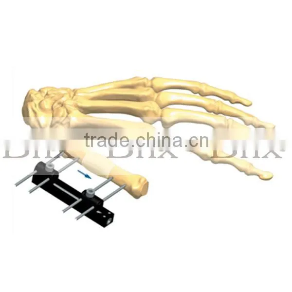 Surgical Deformity Corrcetion External fixator