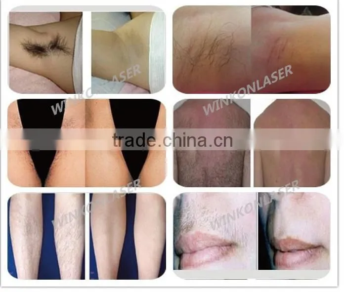 Laser Hair Removal / hair removal laser / laser hair removal machine