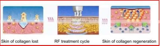 portable rf wrinkle removal face lifting device from weifang KM